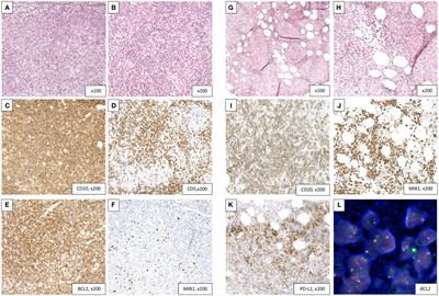 Case report: From sequence to solution: tailoring treatment for transformed follicular lymphoma (DLBCL) through next generation sequencing study